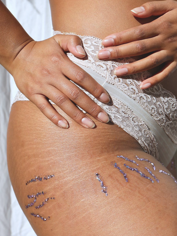 Can You Fully Get Rid Of Stretch Marks?