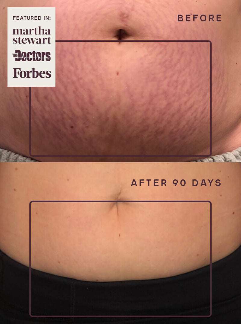 OUR 90-DAY STRETCH MARK FREE KIT OUR 90-DAY STRETCH MARK FREE KIT