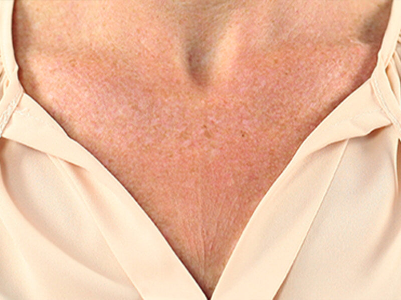 Booby-Wrinkle-Removal-Product-Before Booby-Wrinkle-Removal-Product-Before