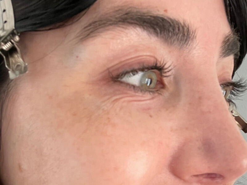 Eye-Wrinkle-Removal-Product-Before Eye-Wrinkle-Removal-Product-Before