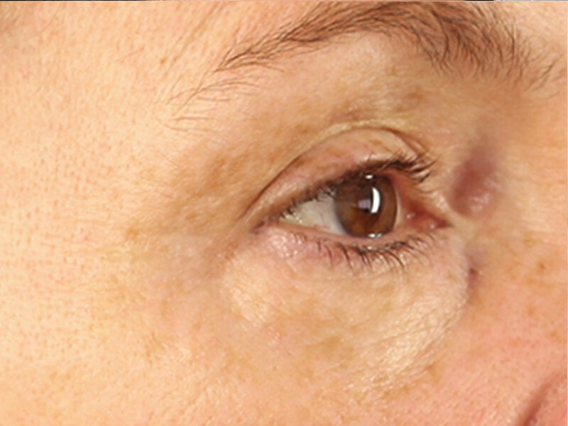 Eye-Wrinkle-Removal-Products-After Eye-Wrinkle-Removal-Products-After