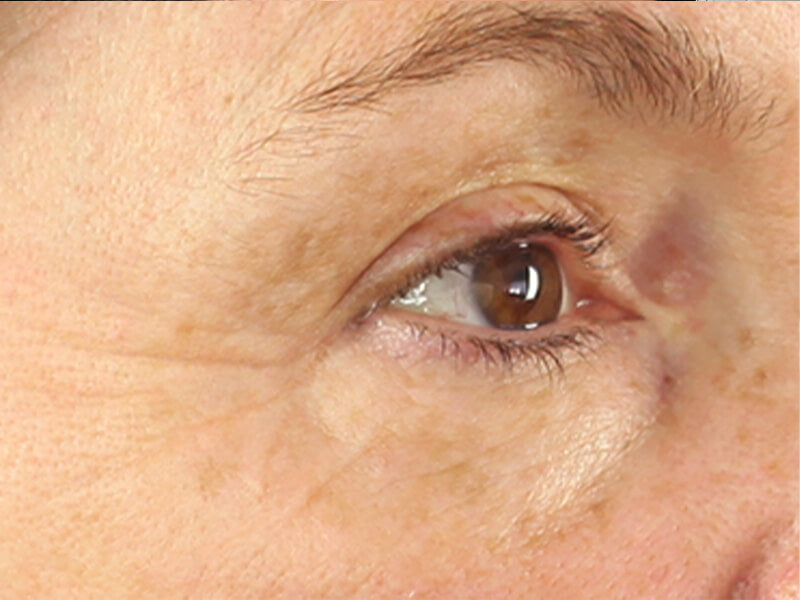 Eye-Wrinkle-Removal-Products-Before Eye-Wrinkle-Removal-Products-Before