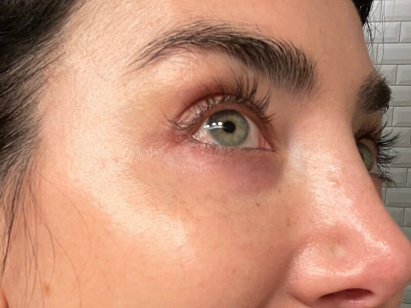 Eye_Wrinkle_After Eye_Wrinkle_After