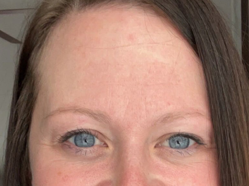 Forehead-Wrinkle-After Forehead-Wrinkle-After