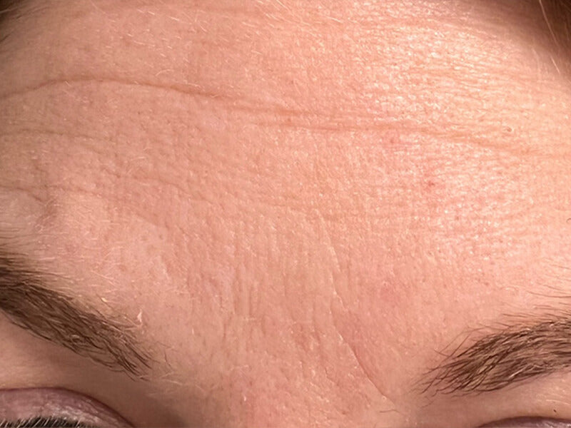 Forehead-Wrinkle-Before-Rachael Forehead-Wrinkle-Before-Rachael