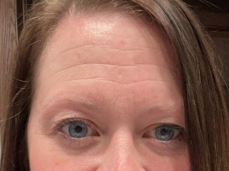 Forehead-Wrinkle-Before Forehead-Wrinkle-Before