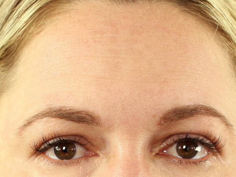 Forehead-Wrinkle-Removal-Product-After Forehead-Wrinkle-Removal-Product-After