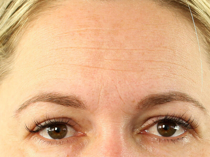Forehead-Wrinkle-Removal-Product-Before Forehead-Wrinkle-Removal-Product-Before