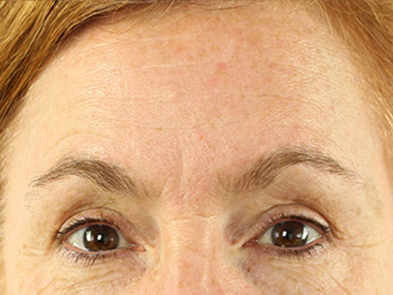 Forehead-Wrinkle-Removal-Products-After Forehead-Wrinkle-Removal-Products-After