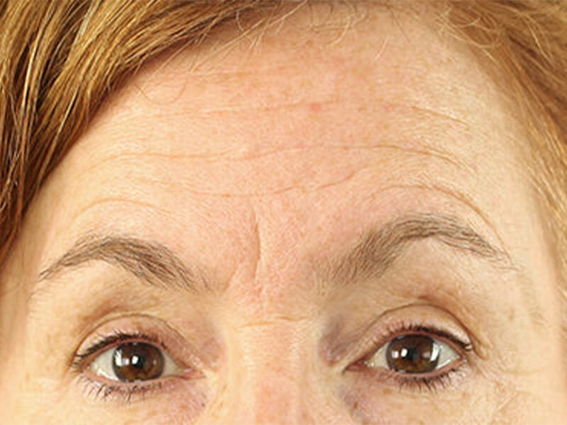 Forehead-Wrinkle-Removal-Products-Before Forehead-Wrinkle-Removal-Products-Before