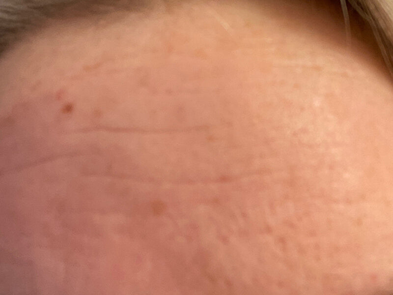 Forehead-Wrinkles-Removal-Product-After Forehead-Wrinkles-Removal-Product-After