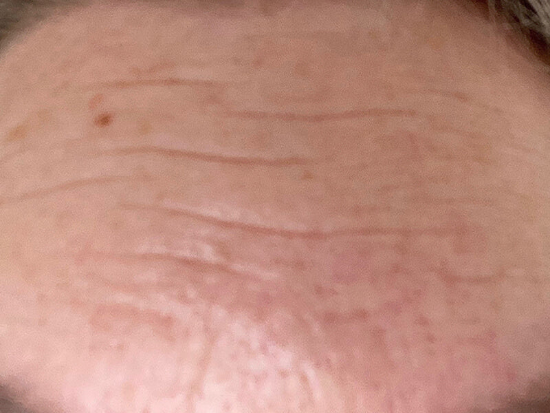 Forehead-Wrinkles-Removal-Product-Before Forehead-Wrinkles-Removal-Product-Before
