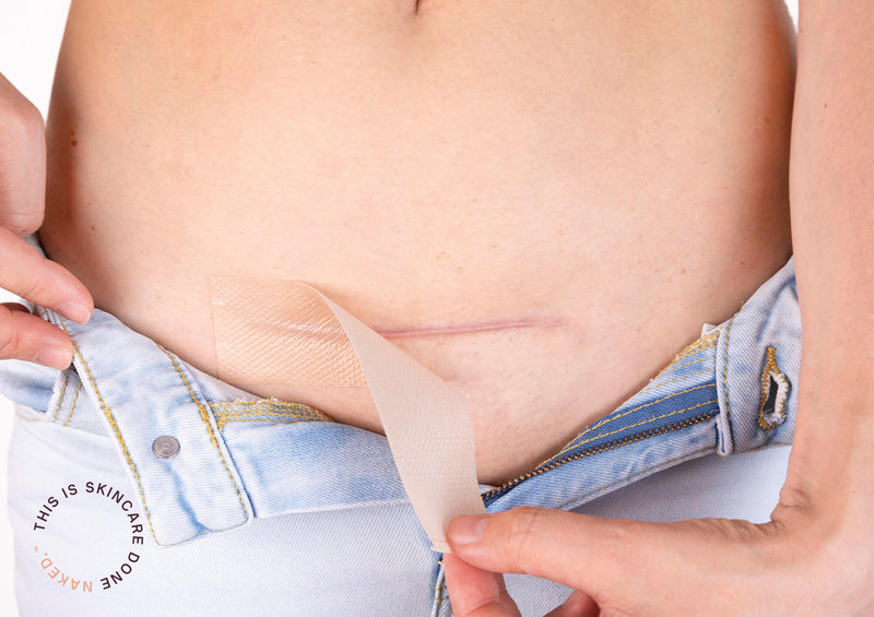 How-C-Section-Patches-Work Silicone Fusion