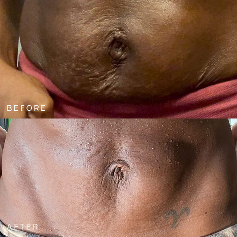 Belly & Body Stretch Mark Kit
