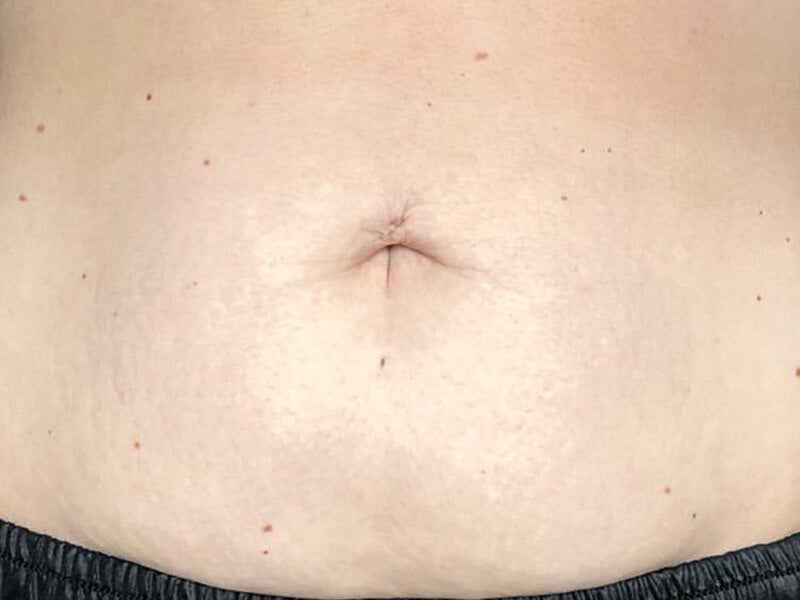 Loose-Skin-Tightening-Product-After Loose-Skin-Tightening-Product-After