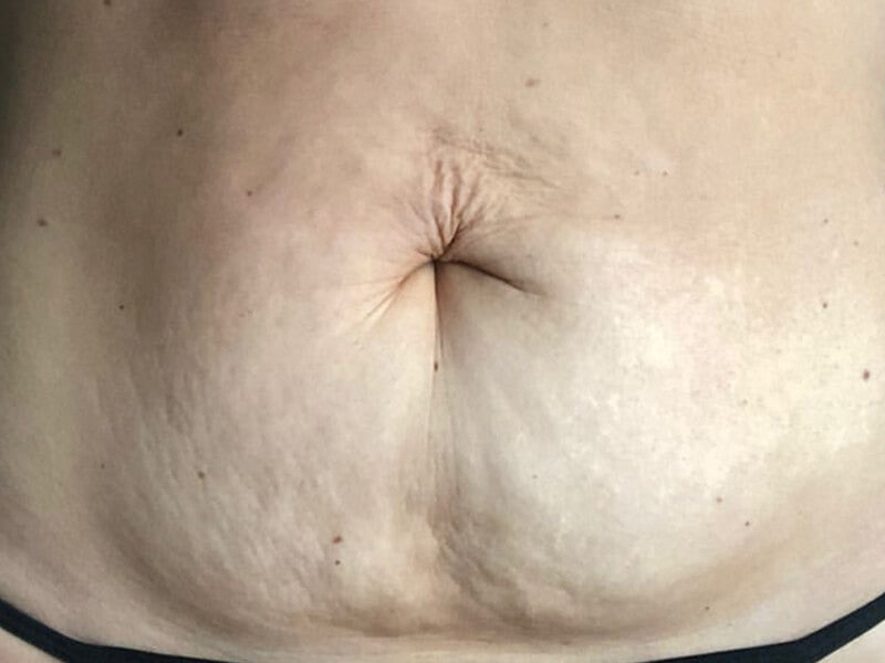 Loose-Skin-Tightening-Product-Before Loose-Skin-Tightening-Product-Before