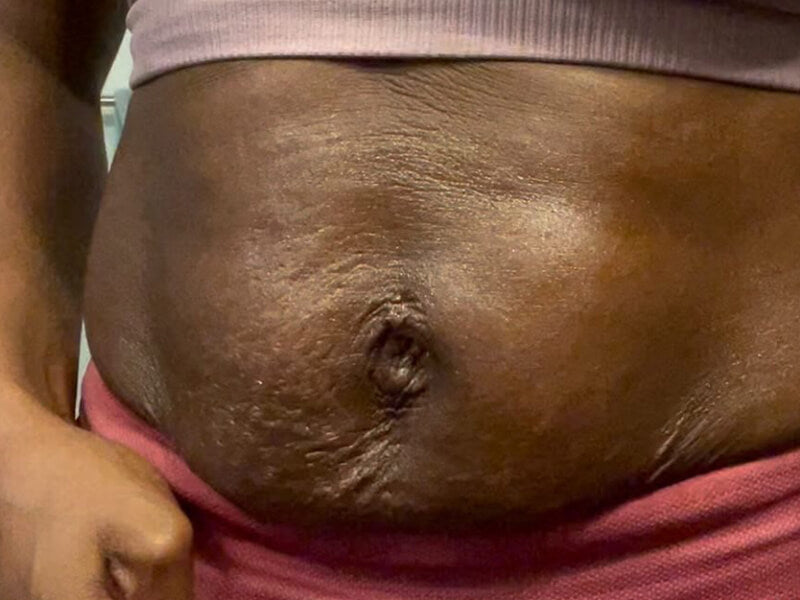 Loose_Skin_Stretch_Mark_Before Loose_Skin_Stretch_Mark_Before