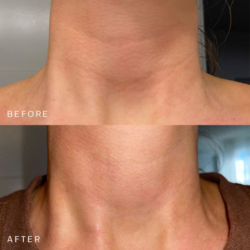 Prime Neck Occlusion Patch™
