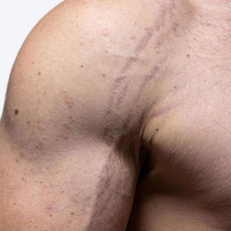 Post-Workout Stretch Mark Kit