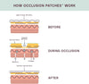 Chest & Body Occlusion Patch™