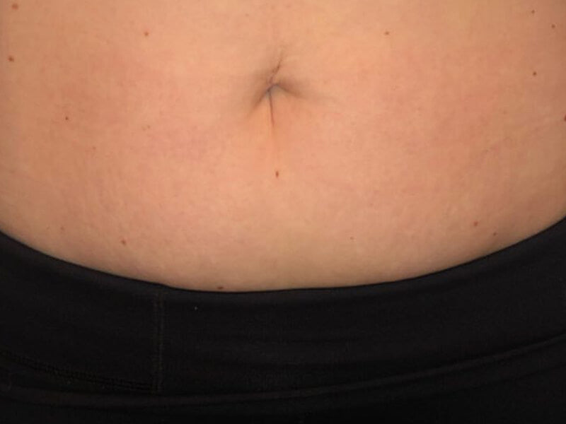 Stretch-Mark-Removal-Product-After Stretch-Mark-Removal-Product-After