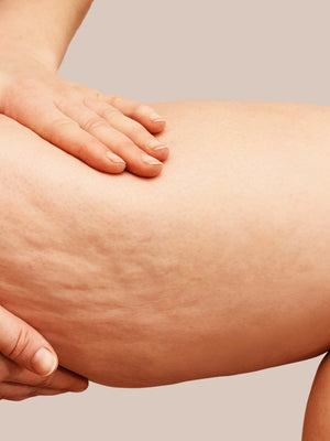 What Do Stretch Marks Look Like?