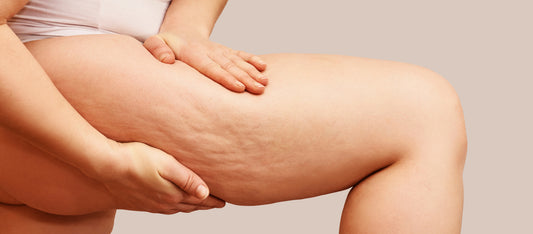 What Do Stretch Marks Look Like?