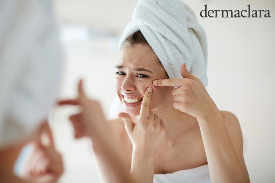 Prevent and Get Rid of Acne Scars and Dark Marks