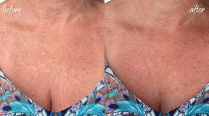 Dermaclara Clarafuse Chest Reviews