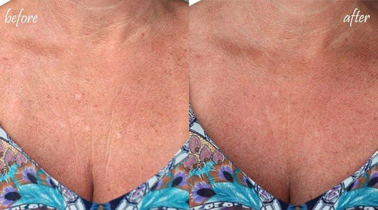 Silicone Fusion Treatment Results