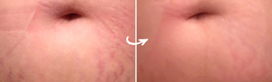 Clarafuse Stretch Marks Before and Afters