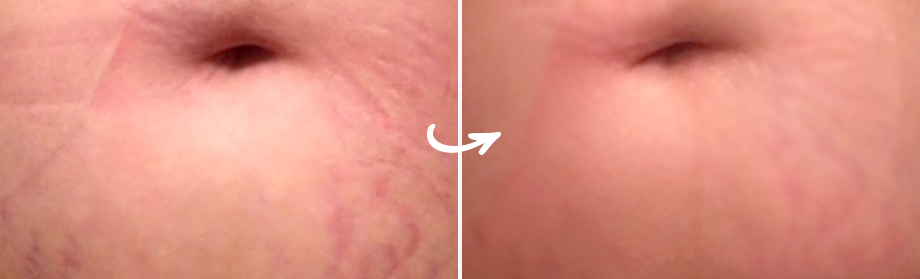 Clarafuse Stretch Mark Treatment Review