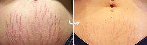Clarafuse Stretch Marks Results