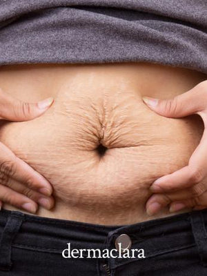 Clarafuse Silicone Fusion Stretch Mark Treatment