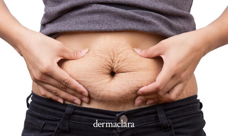 Clarafuse Silicone Fusion Stretch Mark Treatment