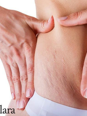 Education: How Common Are Stretch Marks On Women?