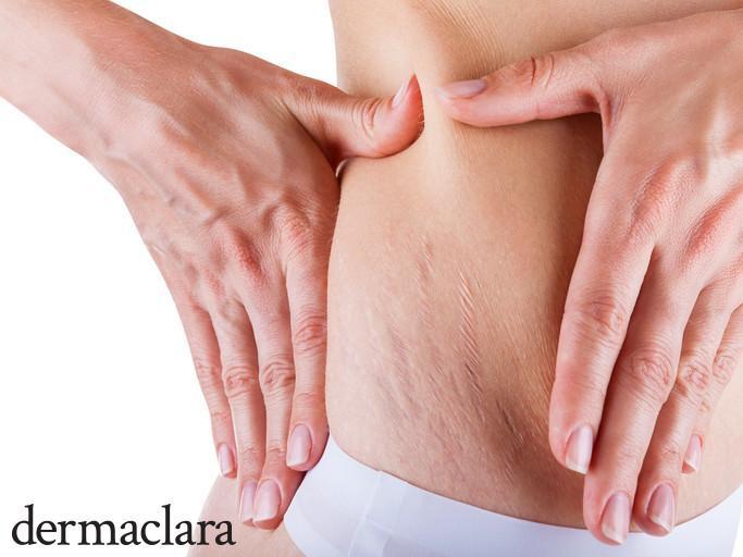 Education: How Common Are Stretch Marks On Women?