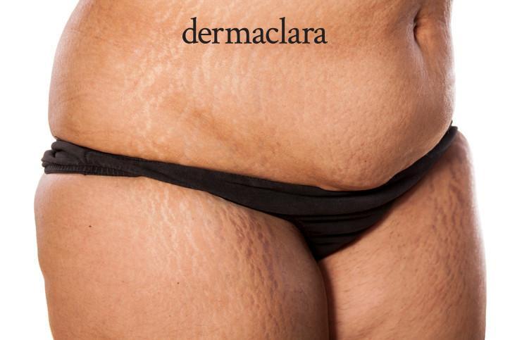 Does Dermaclara Clarafuse Work On All Skin Types And Skin Tones?