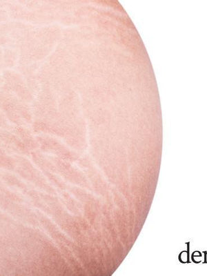 How To Reduce Appearance Of Stomach Stretch Marks
