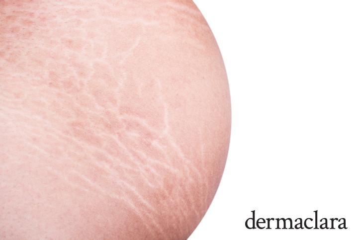 How To Reduce Appearance Of Stomach Stretch Marks