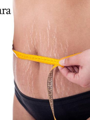 Most Effective Treatment For Pregnancy Stretch Marks