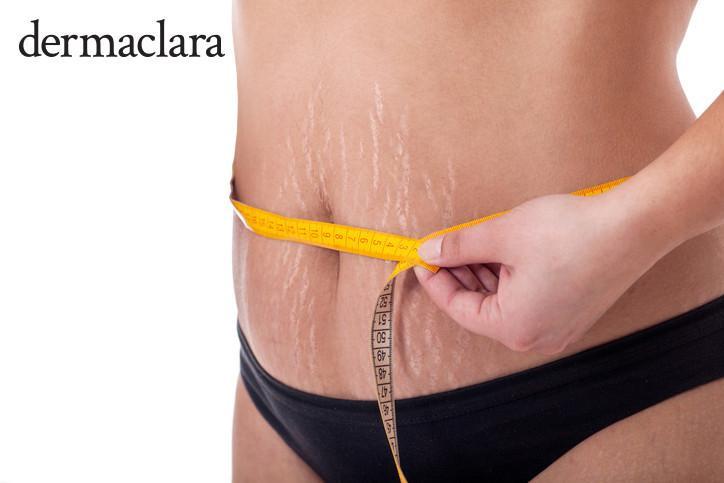Most Effective Treatment For Pregnancy Stretch Marks