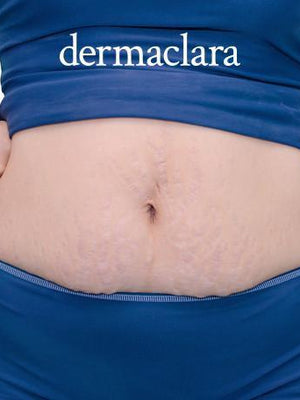 How To Reduce Weight Loss Stretch Marks