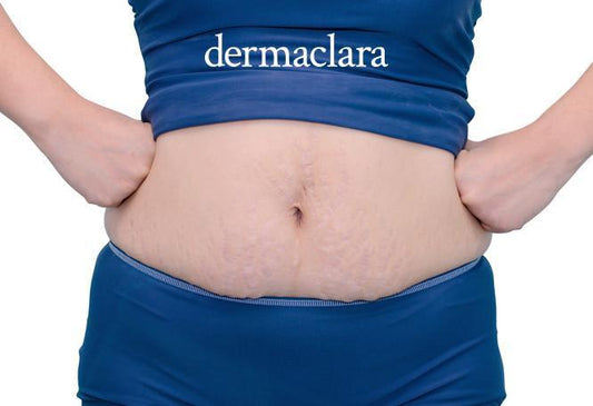 How To Reduce Weight Loss Stretch Marks