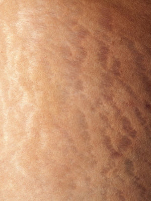 Education: How Are Stretch Marks On Women Formed?