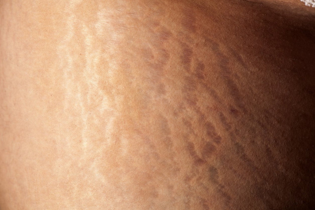 Education: How Are Stretch Marks On Women Formed?