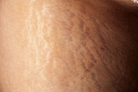 Education: How Are Stretch Marks On Women Formed?