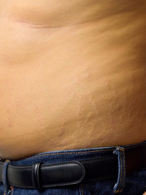 All The Colors Of Stretch Marks & How To Treat Them