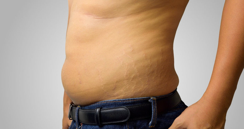 All The Colors Of Stretch Marks & How To Treat Them