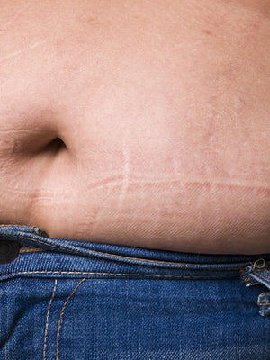 Stretch Mark Silicone Fusion Technology Reviews